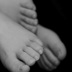 Club Foot
